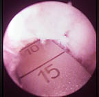 Trapianto osteocondrale con mosaicoplastica