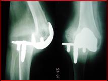 L'immagine descrive una complicanza precoce di protesi di Freman per grave instabilità