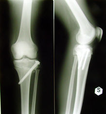 foto e radiografie post-operatorie dopo osteotomia tibiale di sottrazione e di derotazione a sinistra