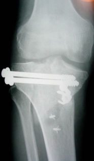 L'immagine mostra postumi di frattura del piatto tibiale con residua deformità in varo