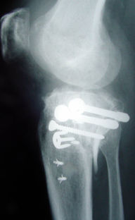 L'immagine mostra i postumi di fratture del piatto tibiale con residua deformità in varo