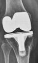 mobilizzazione con osteolisi e grave instabilità di protesi di ginocchio