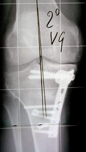 Osteotomia tibiale di addizione con associata distacco della TTA: correzione ottimale