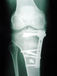 Osteotomia tibiale di addizione con associata distacco della TTA: correzione ottimale