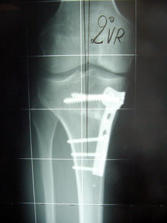 L'immagine mostra una osteotomia tibiale di addizione: risultato a distanza con buona ricostruzione del CFM.