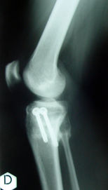 Osteotomia tibio-peroneale di correzione in sottrazione: osteosintesi con viti