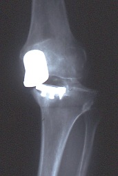 L'immagine mostra una protesi mono mediale con grave instabilità e sub-lussazione