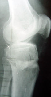 Osteotomia tibiale di addizione