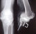 L'immagine mostra una protesi con sostituzione del LCP(PS) in postumi di osteotomia tibiale