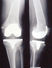 L'immagine mostra una protesi con sostituzione del LCP(PS) in postumi di osteotomia tibiale