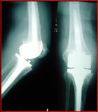 revisione di protesi di ginocchio nel ‘94 con protesi vincolata