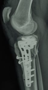 Riduzione ed osteosintesi della frattura con placca mediale e laterale