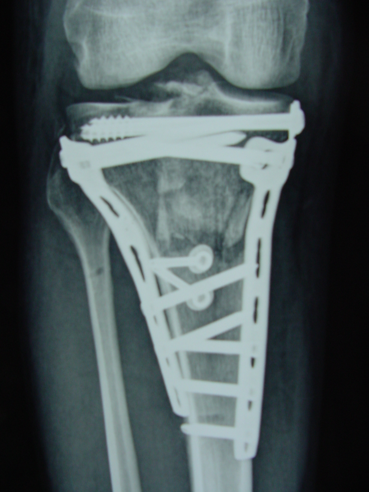 Riduzione ed osteosintesi della frattura con placca mediale e laterale