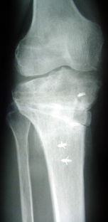 Radiografia di controllo a distanza dopo osteotomia tibiale di addizione