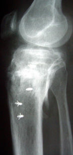 Radiografia di controllo a distanza dopo osteotomia tibiale di addizione
